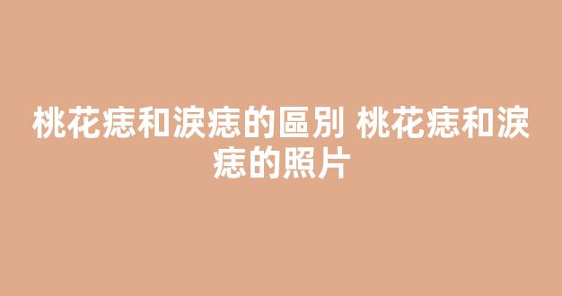 桃花痣和淚痣的區別 桃花痣和淚痣的照片